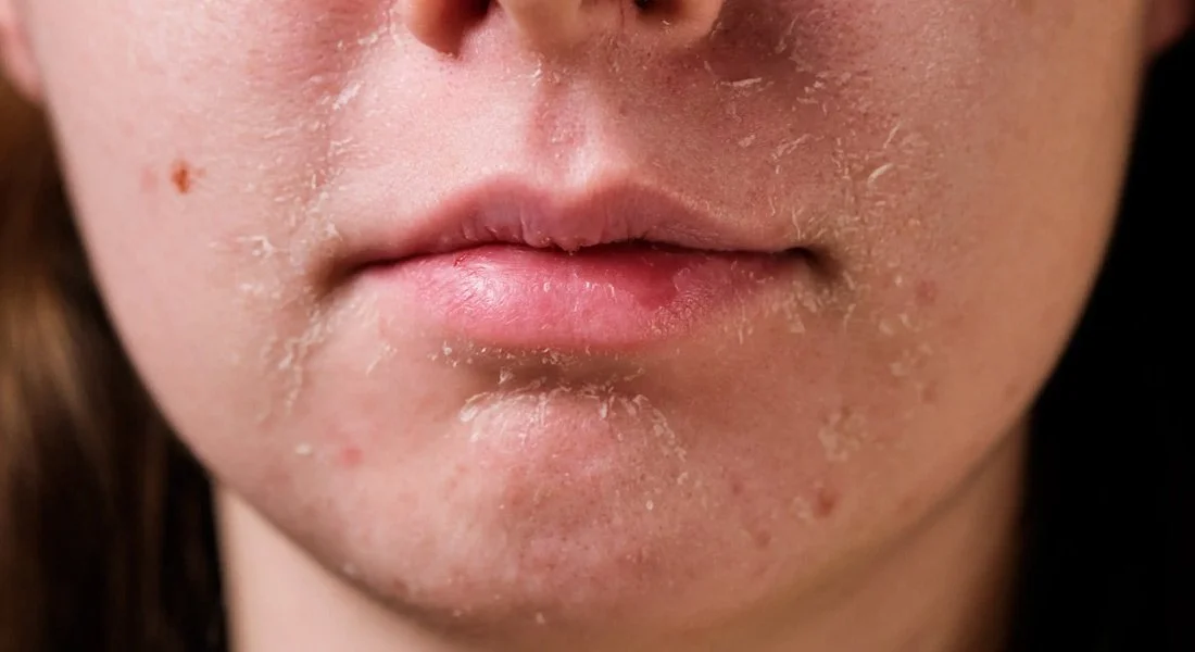 Piel facial con resequedad y descamación