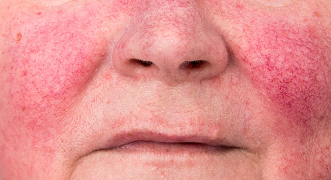 Enrojecimiento facial asociado con rosácea